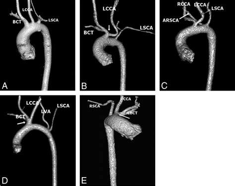 Left Common Carotid Artery