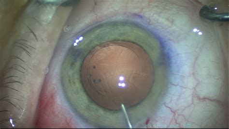 Cirurgia Da Presbiopia Implante De Lente Intra Ocular Trifocal