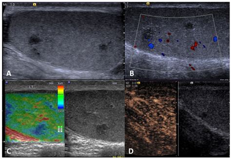 Multiparametric Ultrasound For Diagnosing Testicular Lesions