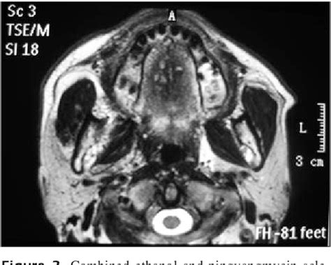 Figure 2 From Digital Subtraction Angiography Dsa Guided Sequential