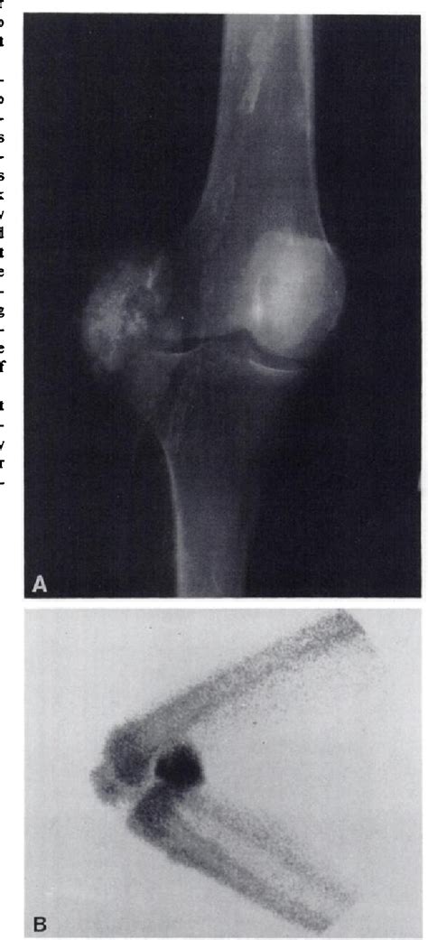 Figure 2 From Periarticular Tumoral Calcinosis And Hypercalcemia In A