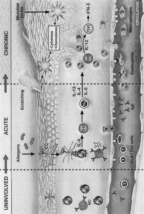 Immunopathogenesis Of Atopic Dermatitis Immunology And Allergy Clinics