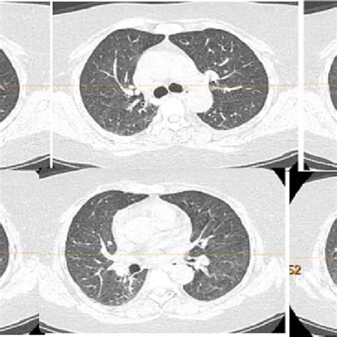 Axial Lung Windows Of The High Resolution Chest CT Scan Revealing