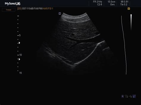 Ultrasound Images Liver B Mode Srf Echogramm №618