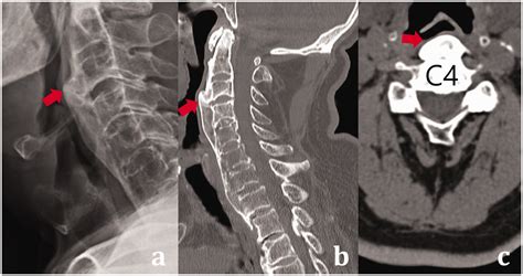 Aggravation Of Dysphagia After Surgical Removal Of Anterior Cervical Osteophytes A Case Report