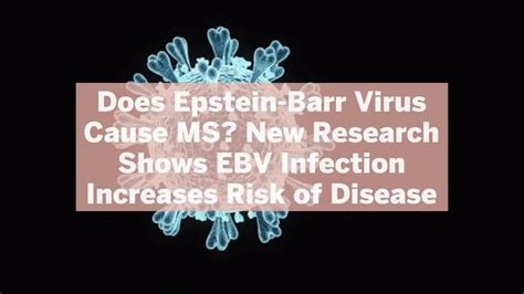 Does Epstein Barr Virus Cause MS New Research Shows EBV Infection