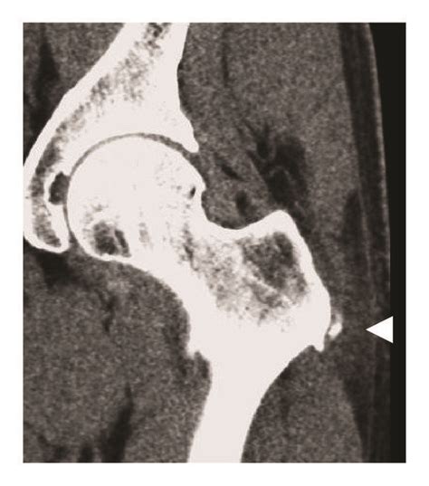 Ct Appearance Of Calcific Tendinitis A Acute Symptomatic Phase