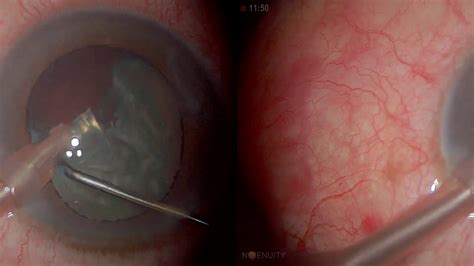 3D Surgery Phacoemulsification In Dense Cataract YouTube