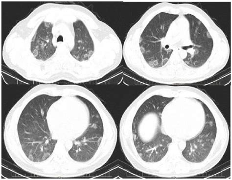 Spiral Chest CT Demonstrates Peripheral Patchy Ground Glass Opacities