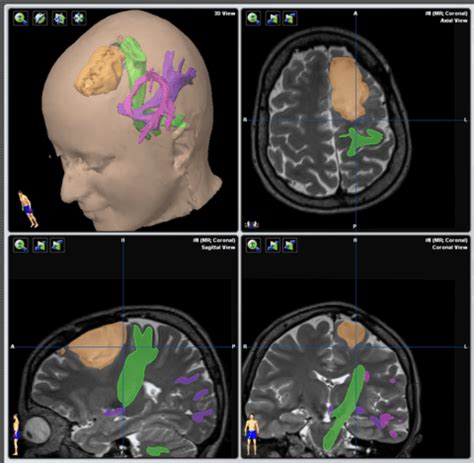 MRI Tractography - Dr. Symeon Missios, MD