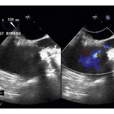 The Image In The Left Panel Shows The Two Dimensional Midesophageal