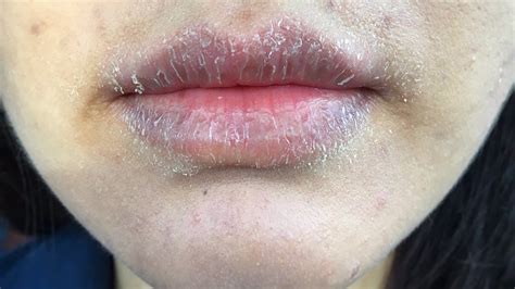 Allergic Reaction On Lips