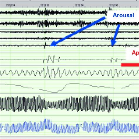 Activité hémodynamique et autonome dans les apnées obstructives du