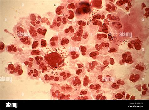 Trichomonas Vaginalis La Presencia De Las Varillas Y Trichomonads Revelada En La Micrografía