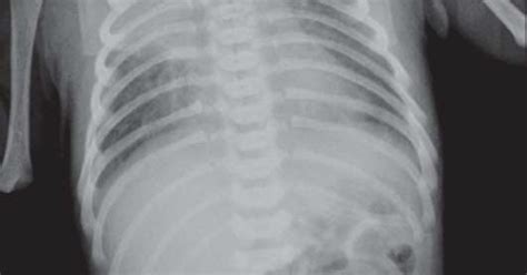 Study Medical Photos: Meconium Aspiration Syndrome - X ray Chest