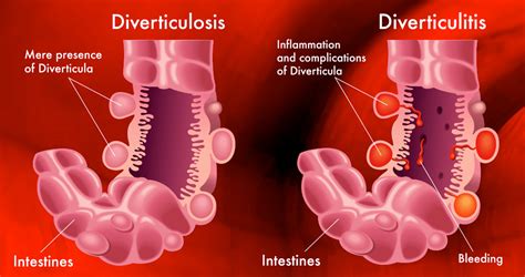 ¿qué Es La Diverticulitis Causas Síntomas Y Tratamientos