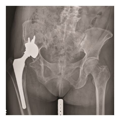 A 61 Year Old Female Patient With Aseptic Loosening Of Right Download Scientific Diagram