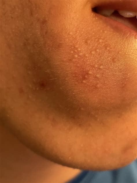 Help with white bumps on face : r/SkincareAddicts