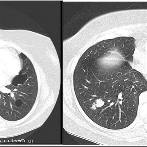 Pulmonary Manifestations Of Amyloidosis Download Table