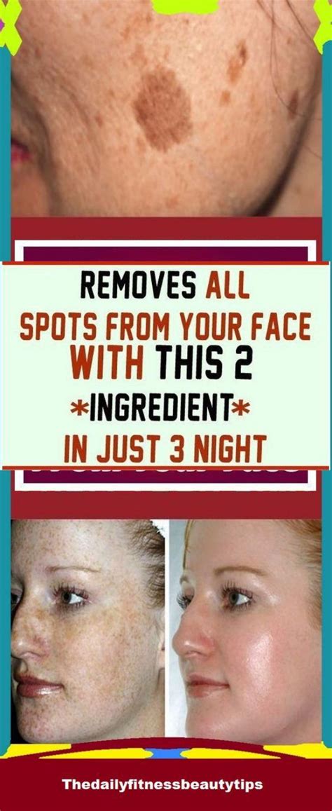 Remove All Spots From Your Face With These 2 Ingredients In Just 3 ...