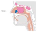 Category:SVG head and neck cancer stages - Wikimedia Commons