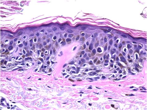 The “dysplastic” Nevus Clinics In Dermatology