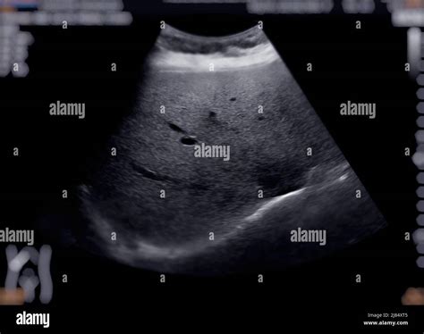 Ultrasound Upper Abdomen Showing Liver And Gall Bladder For Screening