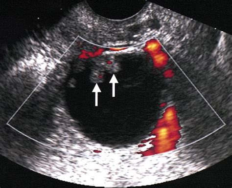 Ovarian Cancer Transabdominal Ultrasound