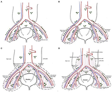 Frontiers The Adequacy Of Pelvic Lymphadenectomy During Radical Cystectomy For Carcinoma