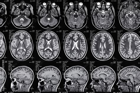 High Resolution Magnetic Resonance Image Scan Of Brain Epi Syndrome