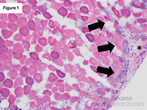 Dermatomyositis Mxa Arkana Laboratories