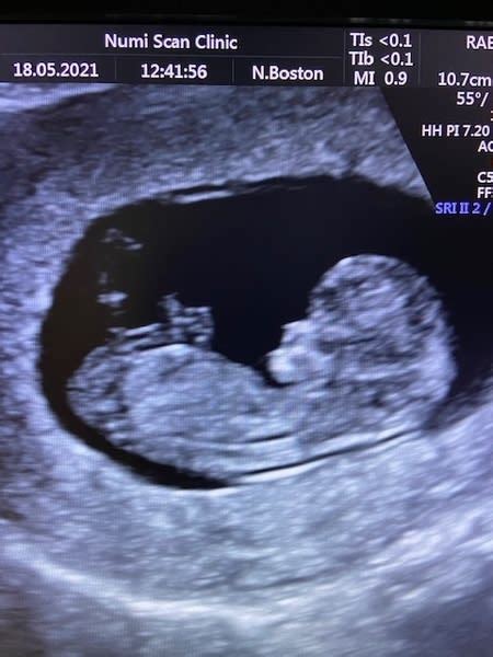 Early Pregnancy Scans Why Have One Numi Scan Gender Scan Muswell Hill Early Pregnancy