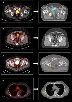 Frontiers PET CT Based Salvage Radiotherapy For Recurrent Prostate