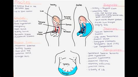 Ascites - Causes, Diagnostic Algorithm, Treatment, Complications - YouTube