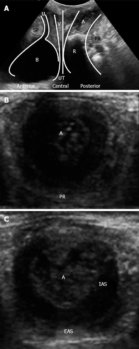 Figure From Current Applications Of Transperineal Ultrasound In