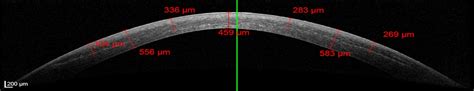 Evaluation Of Biomechanical Changes After Accelerated Cross Cornea