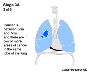 Stage 3 lung cancer | Cancer Research UK