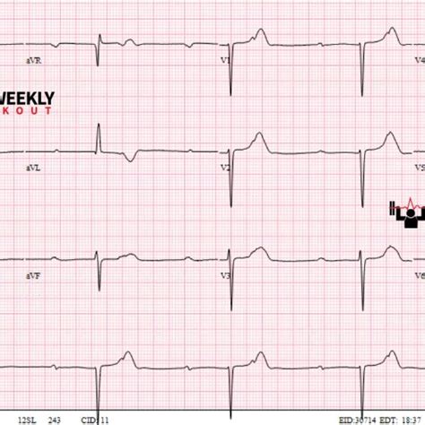 Mobitz II AV block – ECG Weekly