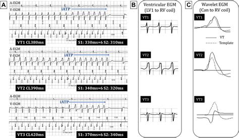 Case Intracardiac Electrogram Egm And Wavelet A Intracardiac