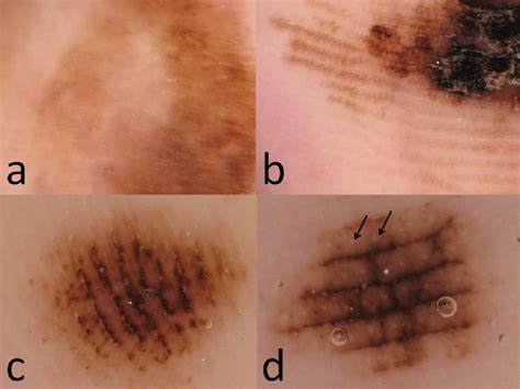 Acral Lentiginous Melanoma Metastatic Melanoma