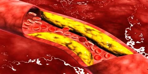 What is Cerebral Arteriosclerosis? | Other Diseases