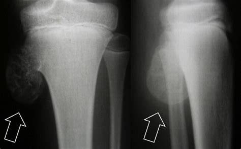 Osteochondroma Causes Symptoms Diagnosis And Osteochondroma Treatment