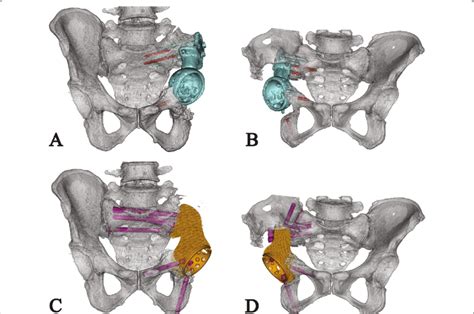 A B Preoperative Simulation Shows Endoprosthesis Migration Blue And Download Scientific