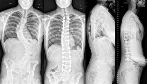 Spinal Deformity Surgery - Spine & Joint Clinic