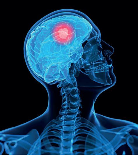 New Immunotherapy Target Discovered For Malignant Brain Tumour