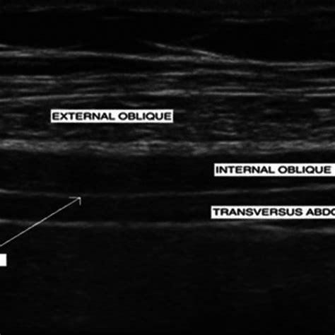 Ultrasound Guided Picture Of Transversus Abdominis Plane Plane Download Scientific Diagram