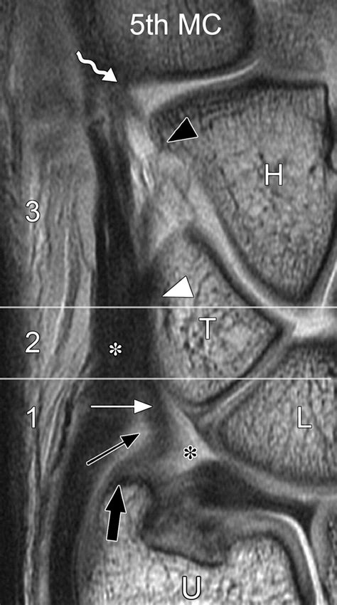 Ulnomeniscal Homologue Of The Wrist Correlation Of Anatomic And Mr