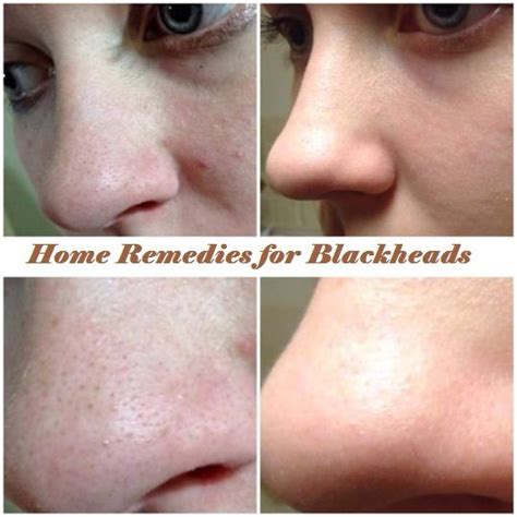 How To Get Rid Of Blackheads On Nose Male - HOWOTRE