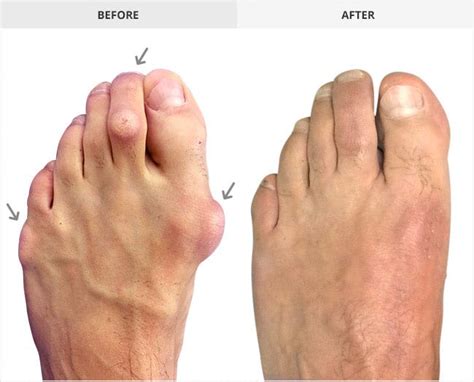 Before After Advantage Foot Ankle Specialist Ferndale M