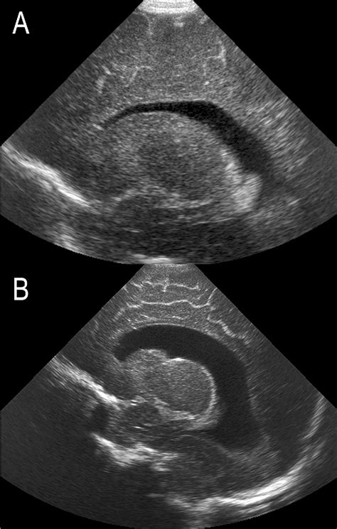 Hydrocephalus Ex Vacuo Semantic Scholar